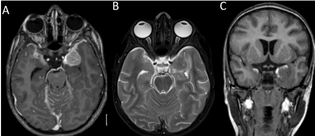 Primary diffuse leptomeningeal melanomatosis in a child with a clinical presentation mimicking meningitis: case report and review of literature