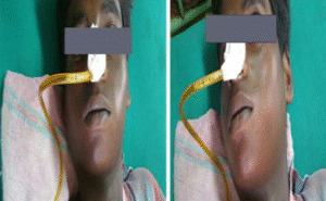 Read more about the article A Curious CA use of Pancreatitis -A Case Report