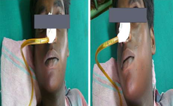 A Curious CA use of Pancreatitis -A Case Report