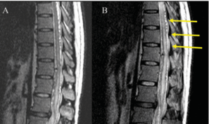 Read more about the article Is Steroid Administration a Cause of Neurological Deterioration  in Patients with Spinal Dural Arteriovenous Fistula?